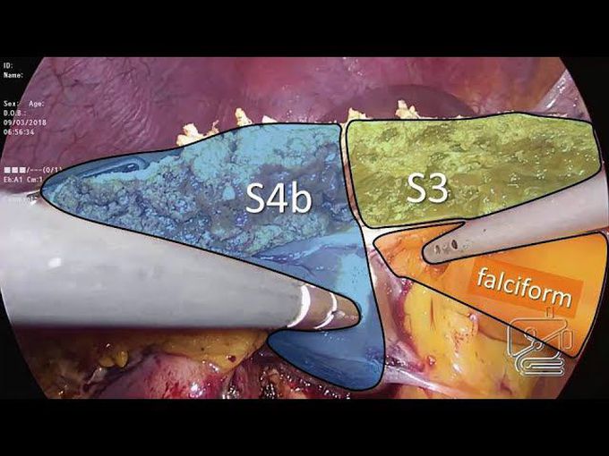 Central hepatectomy: laparoscopic and open approaches