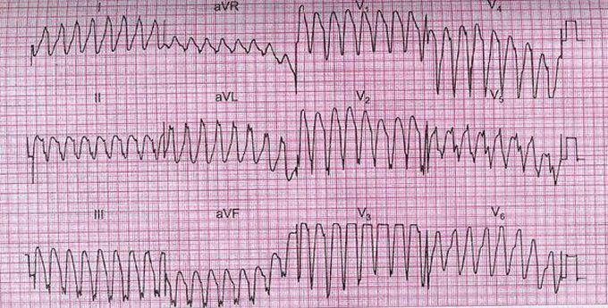 Ventricular tachycardia