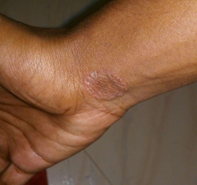 Diagnosis ?