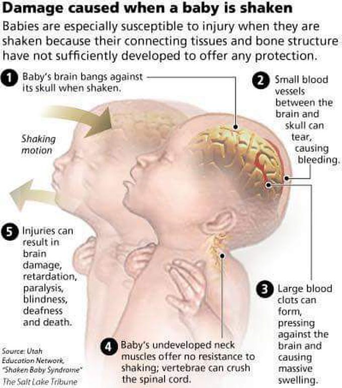 Damage caused when a baby is shaken..