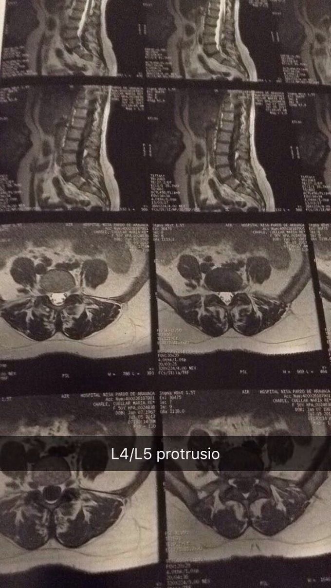 L4/L5 Protrusio