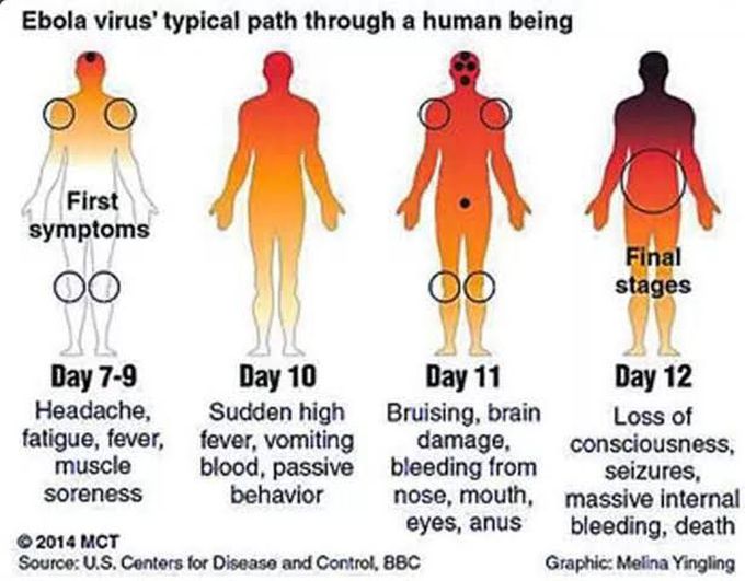 Ebola Virus symptoms