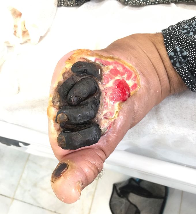 Diabetic foot
