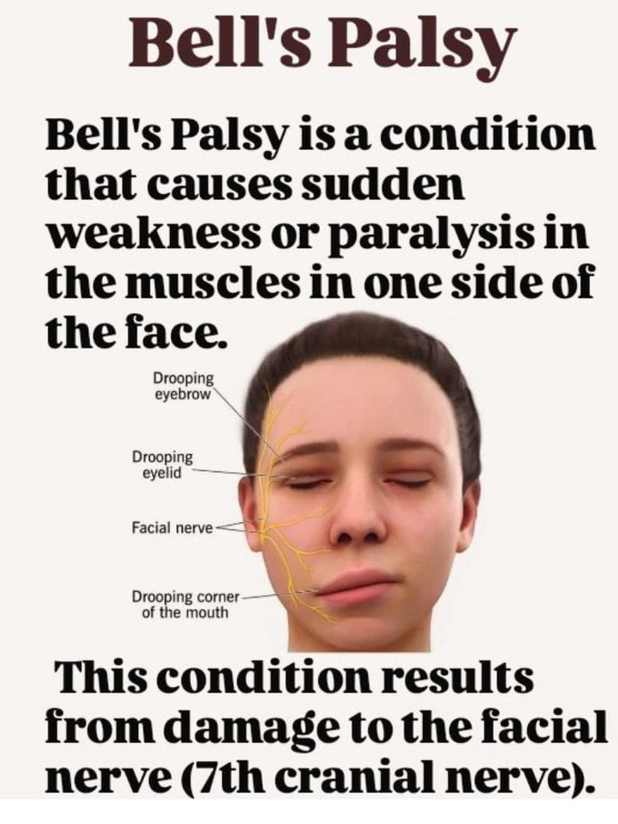 Bell's Palsy