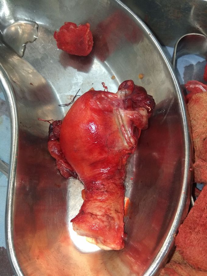 Hysterectomy