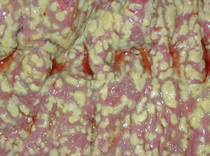 Pseudomembranous colitis