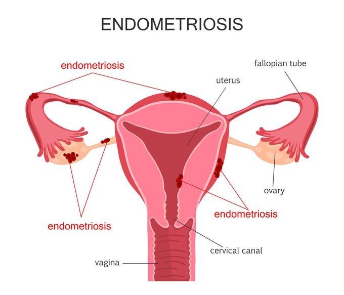 Endometriosis