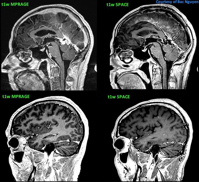 MP-RAGE vs t1w SPACE @ Siemens 3T Skyra #Siemens_MRI #mri - MEDizzy