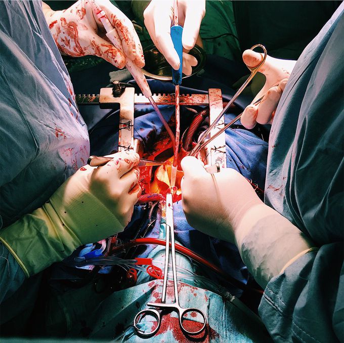 Open-❤️-surgery
