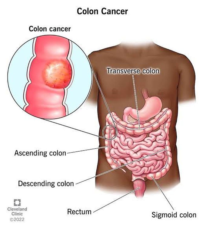 Risk factors of colon cancer