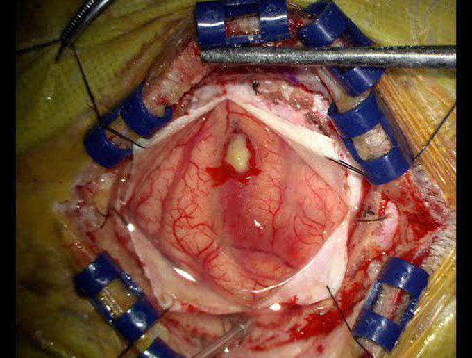 Brain abscess Surgery: Video presentation of a patient who presented with seizure and visual deficit