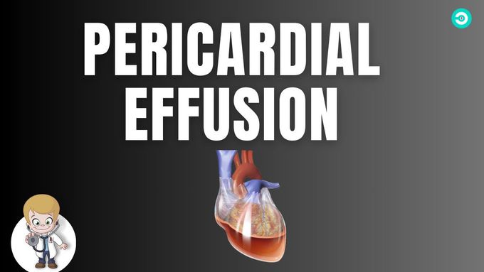 Pericardial Effusion: sign and symptoms, pathophysiology, diagnosis & treatment