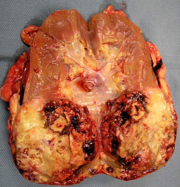 TUMOR
