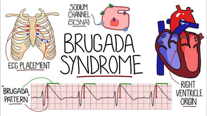 Brugada syndrome