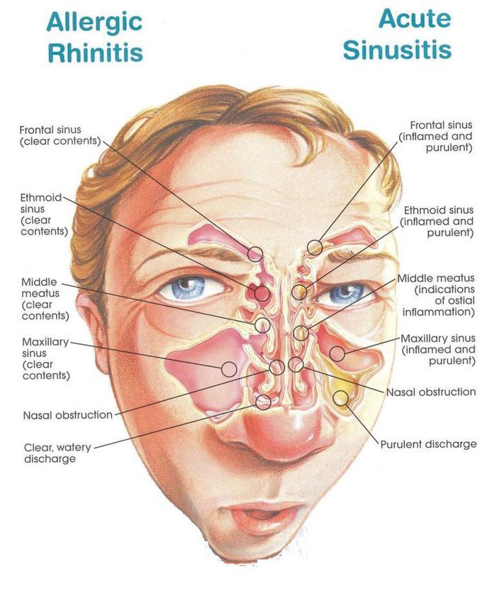 Map of deals the sinuses