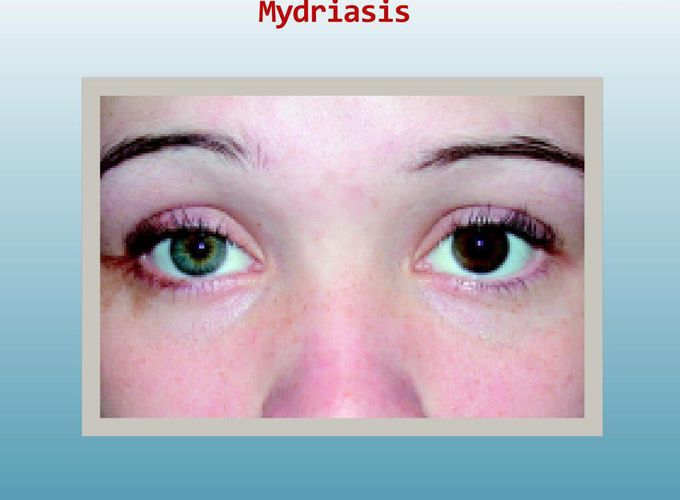 Cause of Mydriasis