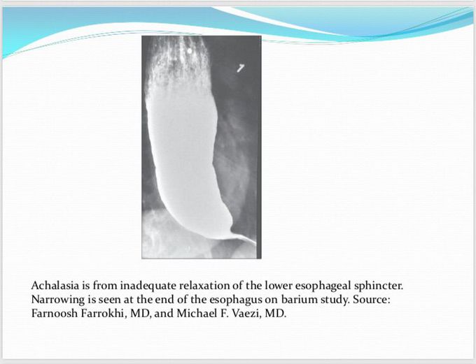 Achalasia which has  bird’s beak apperance