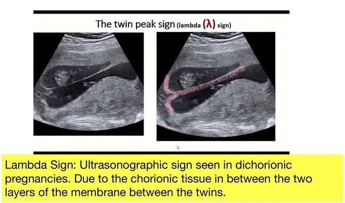 Lambda Sign