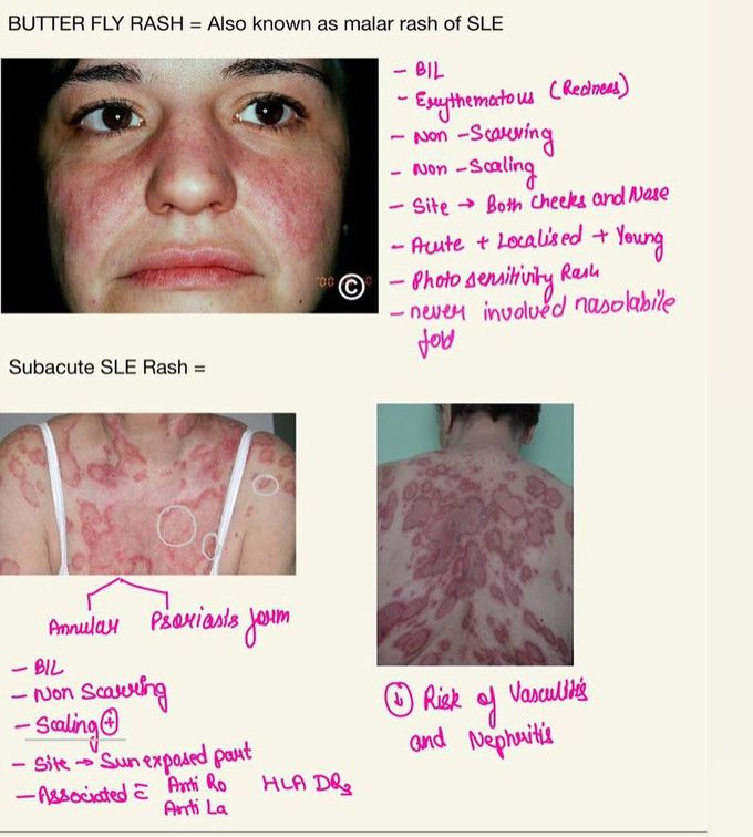 SLE- Skin Manifestations