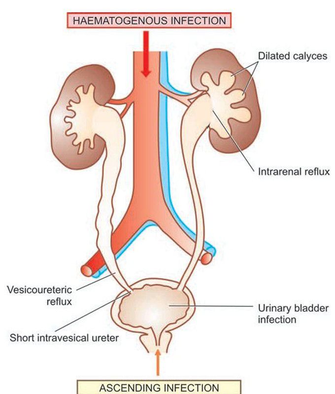 Reflux nephropathy