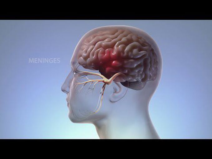 Pain Physiology:
How migraine affects the body