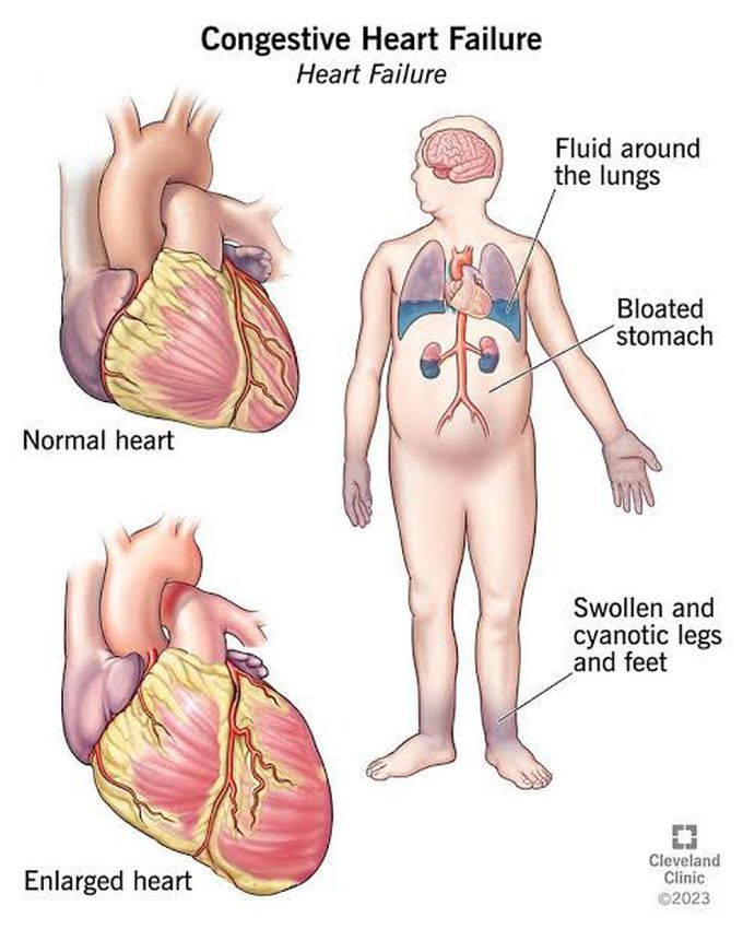 Meals For People With Congestive Heart Failure