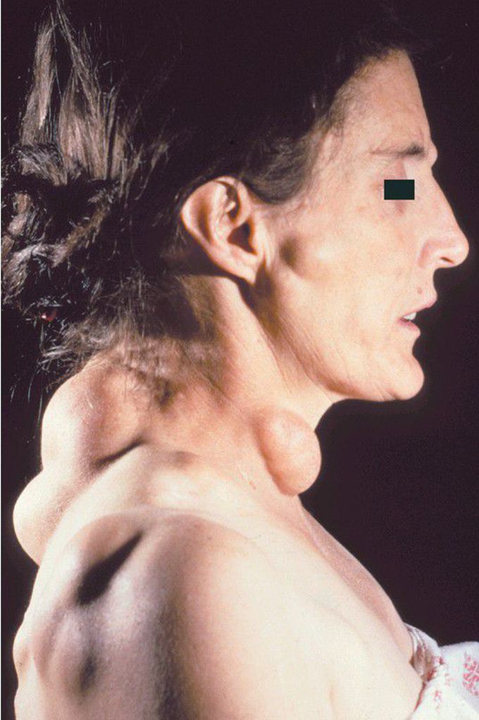 Gardner Syndrome.