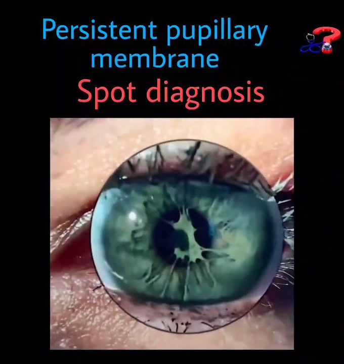 Persistent Pupillary Membrane