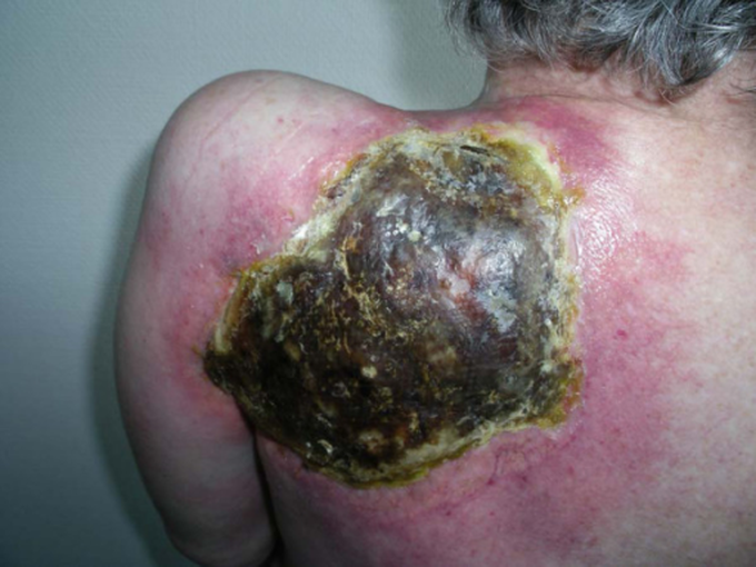 Extensive dermal necrosis in the pre-irradiated scapular region about three weeks after the second dose of pemetrexed.