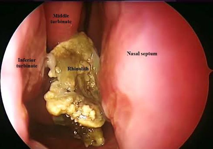 Symptoms of rhinoliths