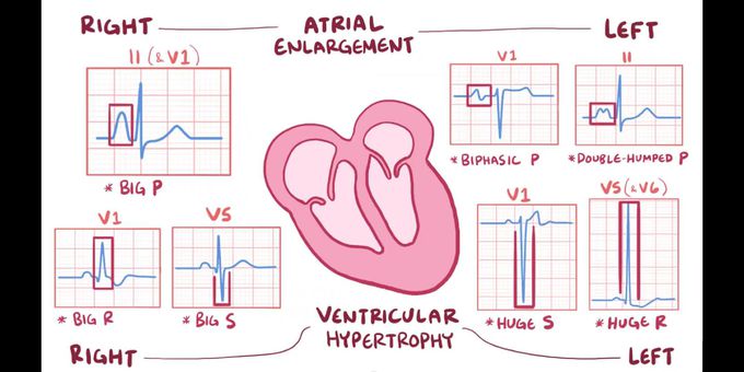 Hypertrophy of heart