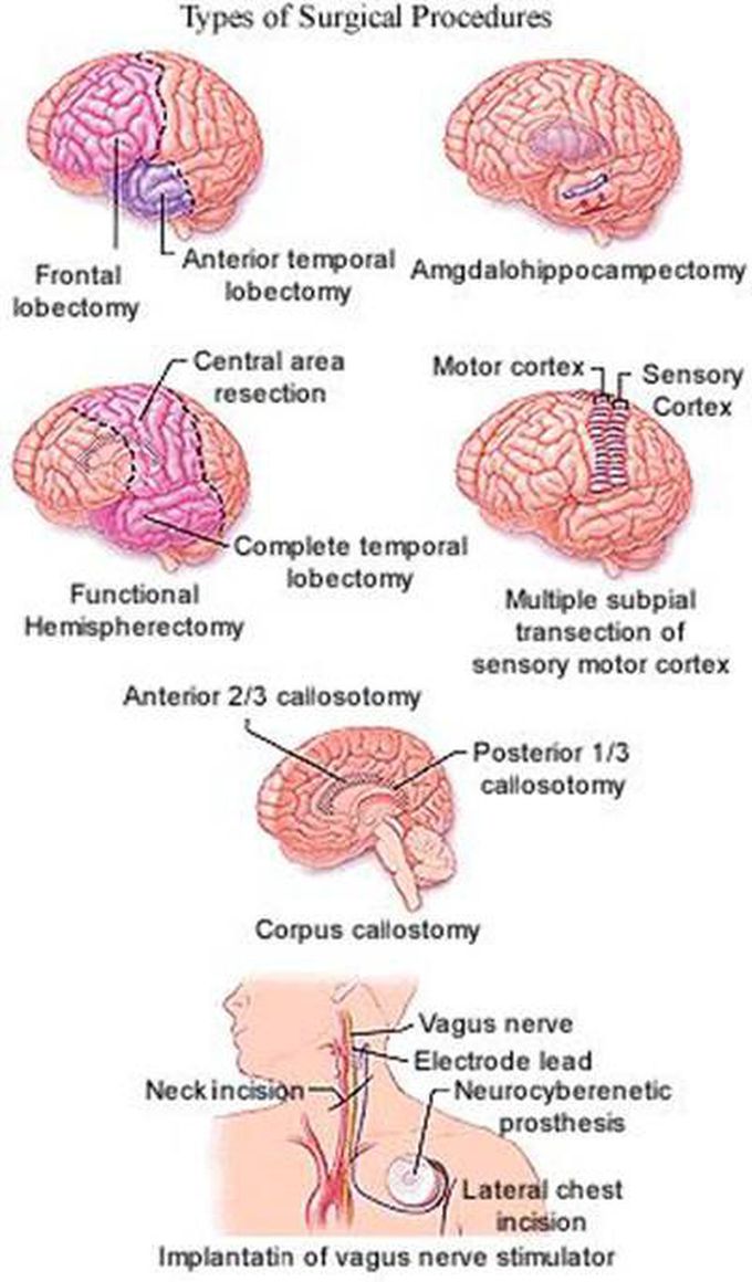 Types of Epilepsy Surgery