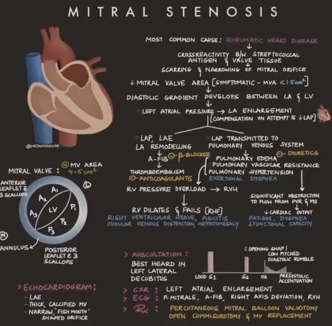 Mitral Valve Stenosis