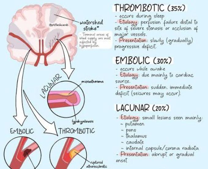 Cause of Embolic stroke