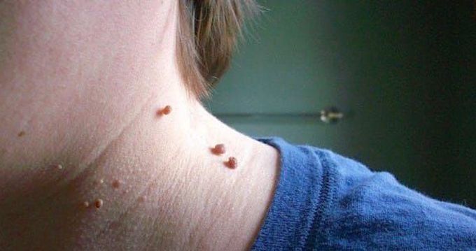 Skin Tags