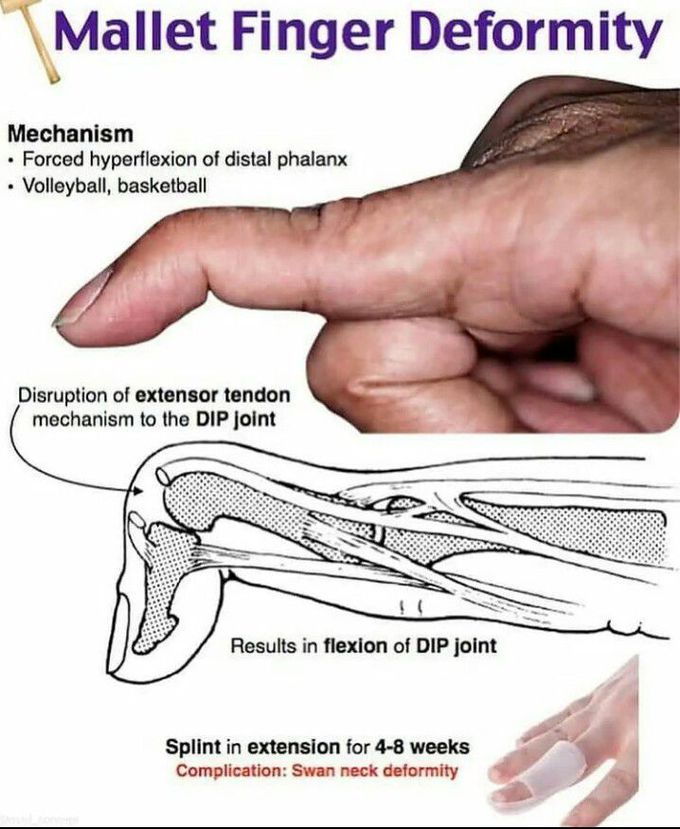 Mallet finger