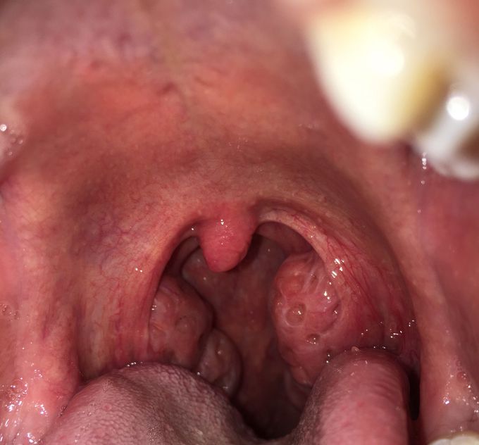 Treatment suggestions?