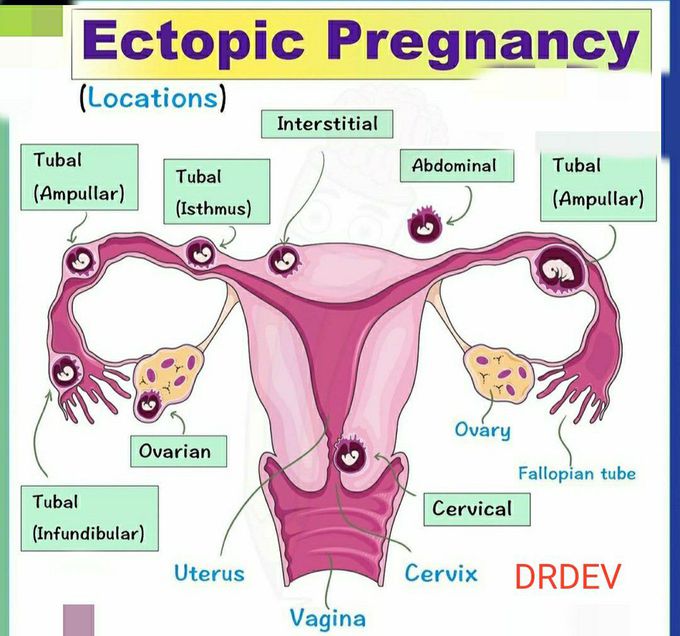 Ectopic pregnancy