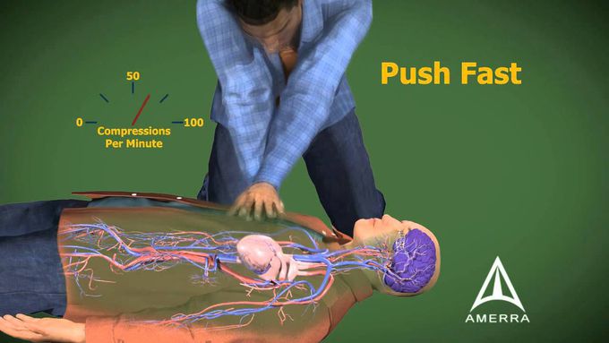 Cardiopulmonary Resuscitation - CPR - 3D Medical Animation