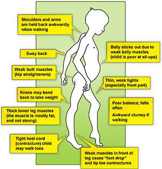 Becker Muscular Dystrophy