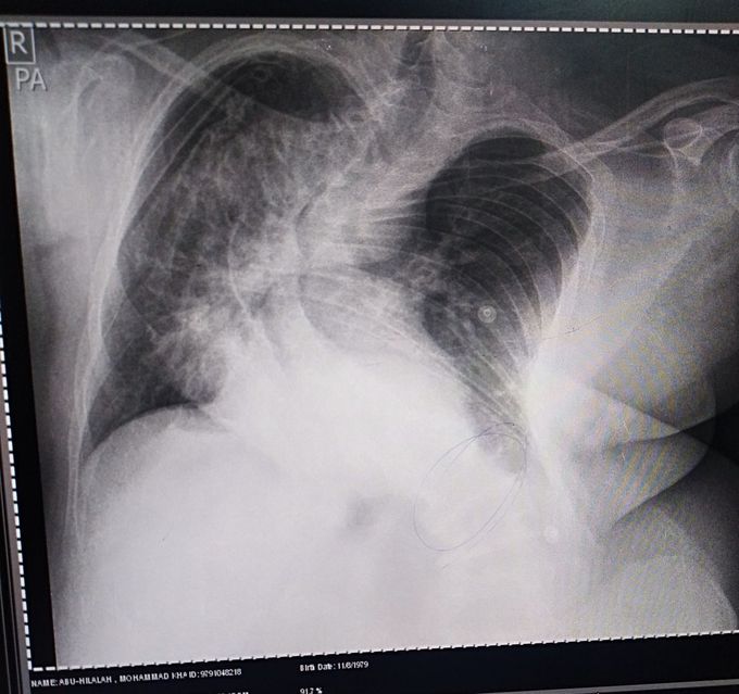 PA CXR