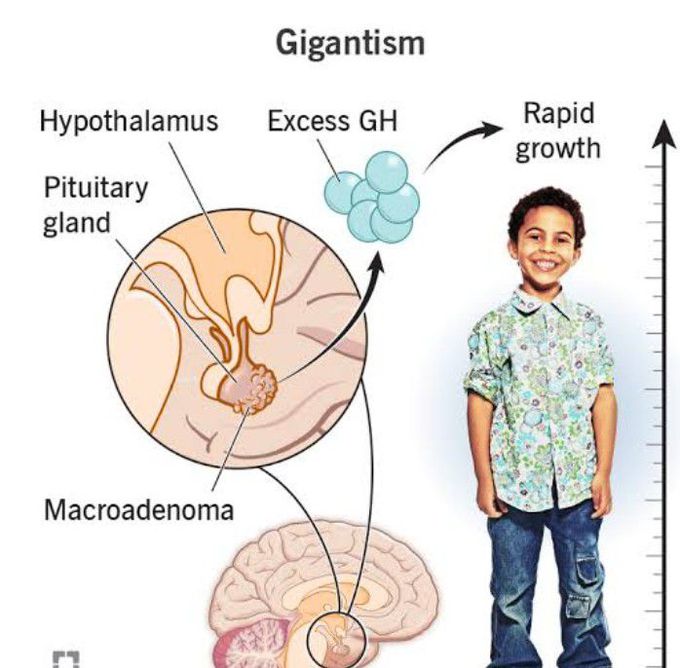 Gigantism