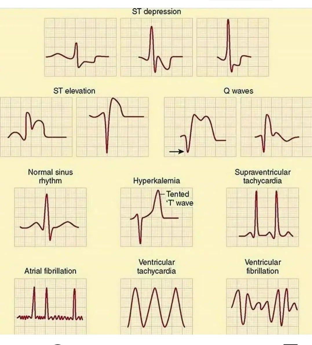 Are There Different Types Of Irregular Heartbeat - Printable Templates ...