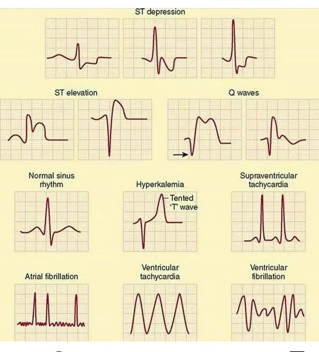 Abnormal Heart Rhythms MEDizzy