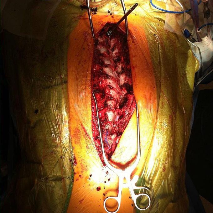 Scoliosis surgery