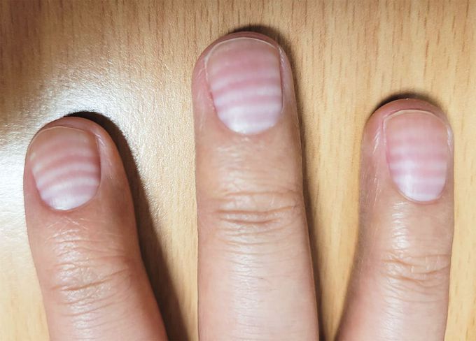 Transverse Leukonychia-Nails-Signs of Diseases-Healthy-Best Homeopathic Doctor-Dr Qaisar Ahmed-Al-Haytham Clinic-Risalpur-KPK-Pakistan