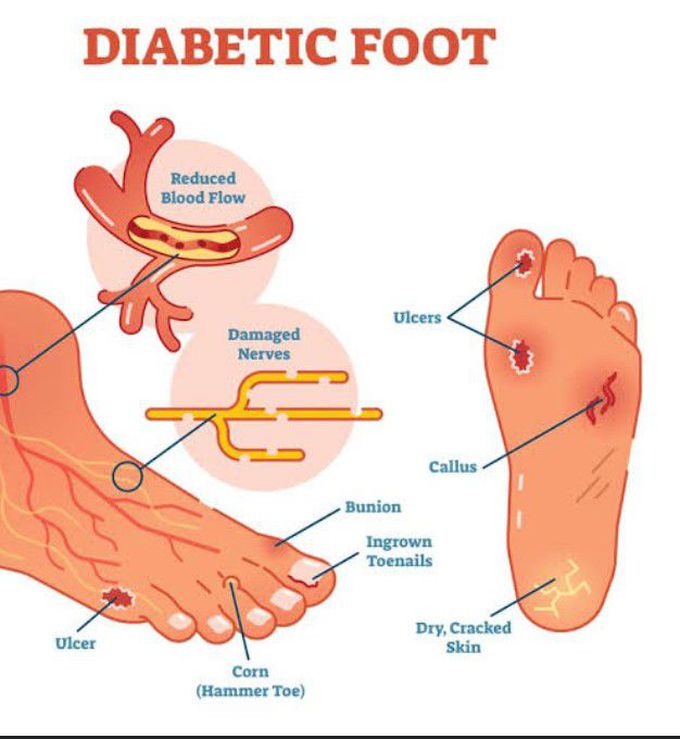 Diabetic Foot