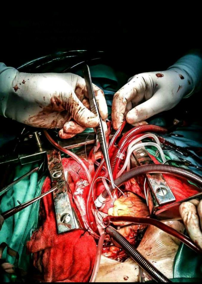 Open heart surgery.