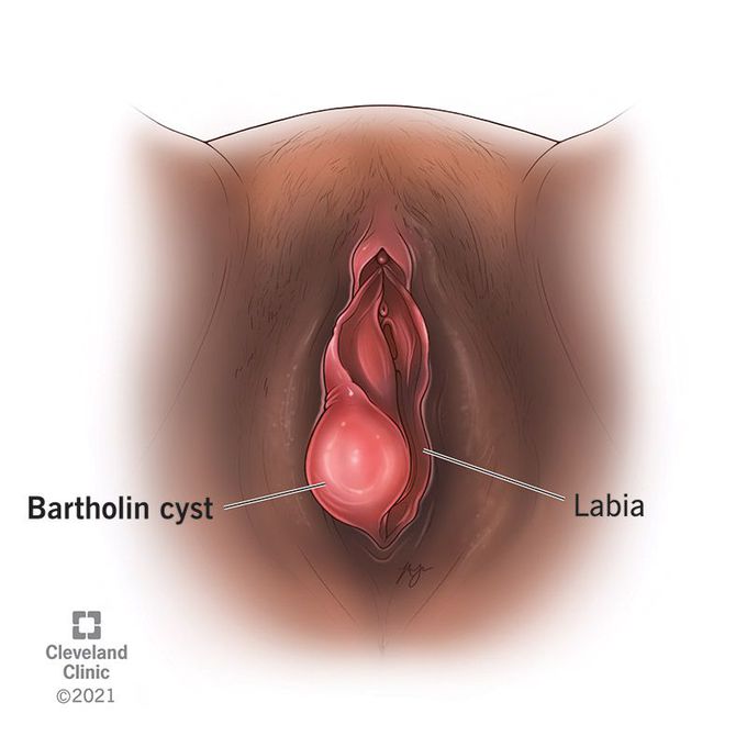 What are the treatment options for vaginal cysts?