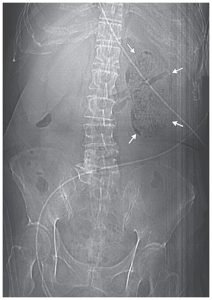 Emphysematous Pyelonephritis